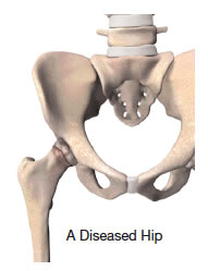 Diseased Hip